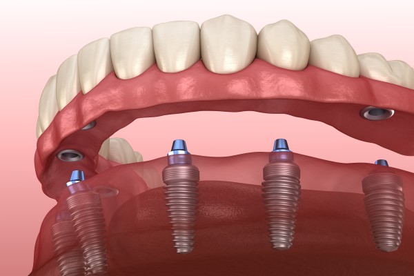 Implant + ball retained removable dentures